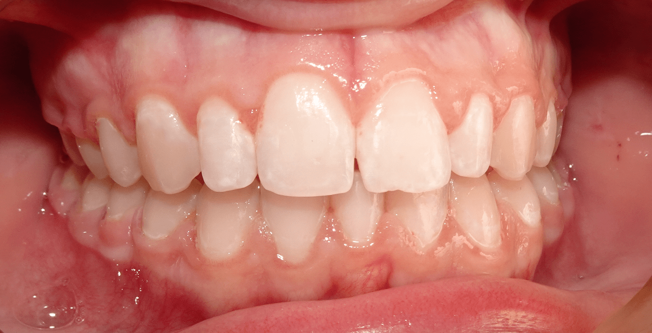 Po leczeniu nakładkami SureSmile – zamknięta diastema, równe zęby