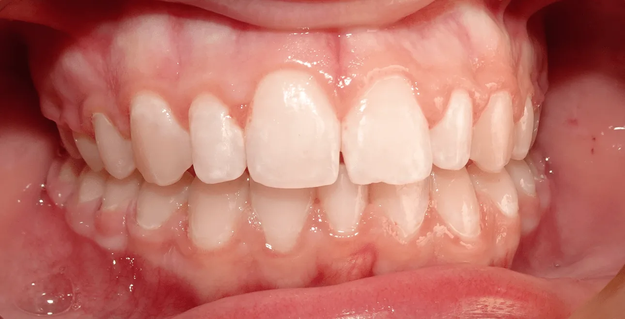 Po leczeniu nakładkami SureSmile – zamknięta diastema, równe zęby