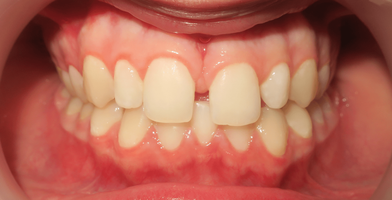 Przed leczeniem – diastema między jedynkami i rotacje zębów bocznych