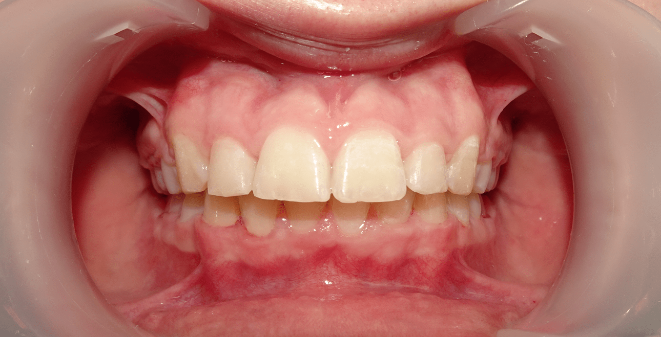 Po leczeniu aparatem metalowym – wyrównane zęby, prawidłowy zgryz