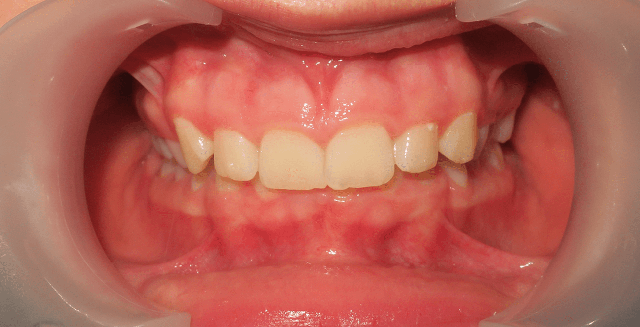 Przed leczeniem – stłoczenie wielozębowe w obu łukach u nastolatka