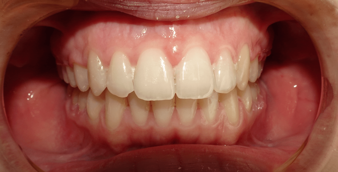 Po leczeniu aparatem ceramicznym – kieł we właściwej pozycji w łuku