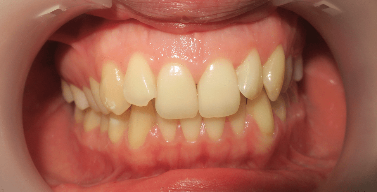 Przed leczeniem – ektopowy kieł górny lewy poza łukiem, stłoczenie