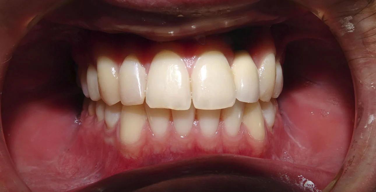 Po leczeniu nakładkami Invisalign – zamknięte przerwy, równy łuk