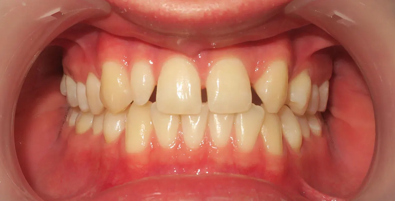 Przed leczeniem – tremy i spacing w łuku górnym
