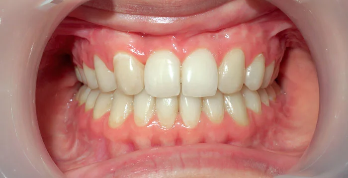 Po leczeniu aparatem stałym – oba łuki wyrównane, prawidłowy zgryz