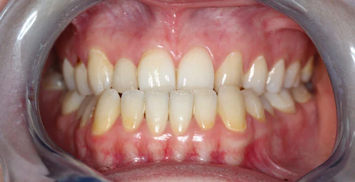 Przed leczeniem – ciężkie stłoczenie wielozębowe w obu łukach u dorosłej pacjentki