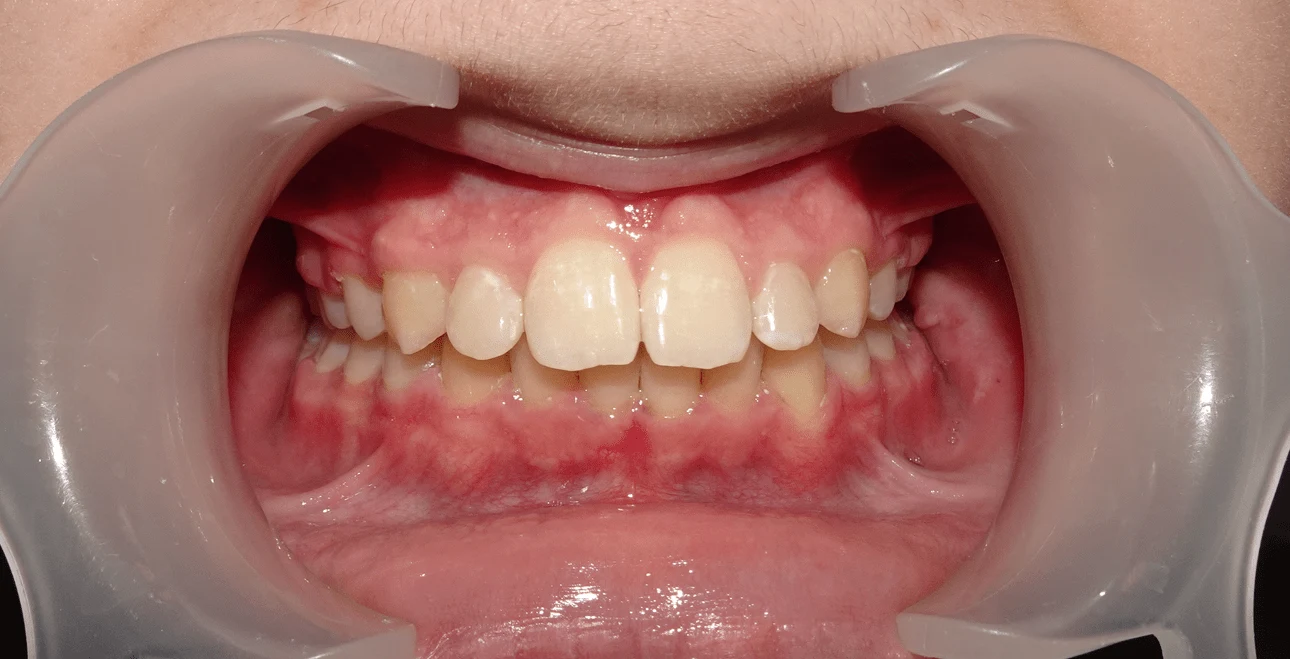 Po leczeniu aparatem metalowym – wyprostowane zęby w obu łukach