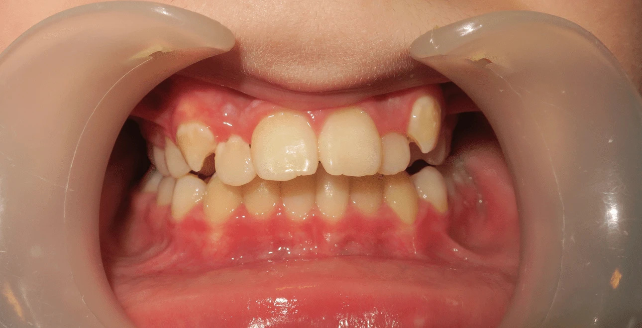 Przed leczeniem – ciężkie stłoczenie wielozębowe u nastolatki