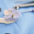 Implantologia – Najczęściej Zadawane Pytania​