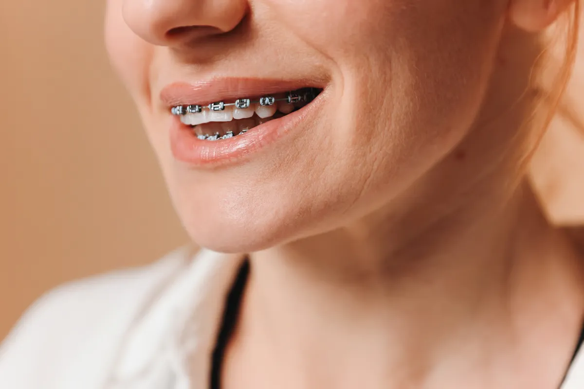 Aparat Na Zeby Dla Doroslych