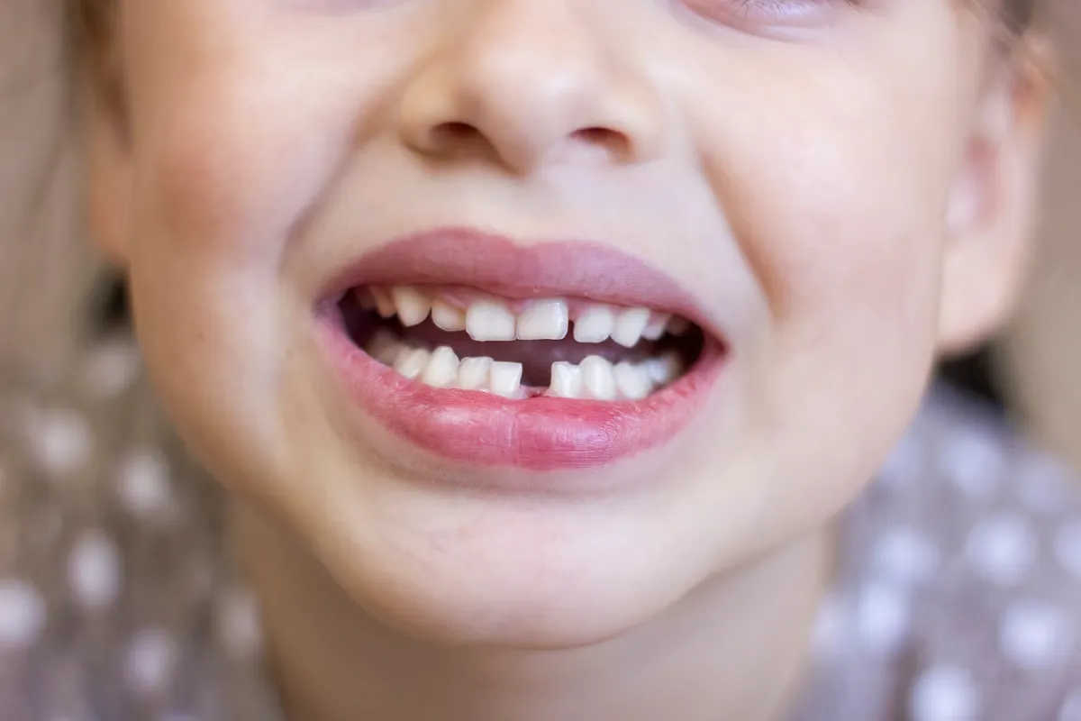 Wady zgryzu u dzieci