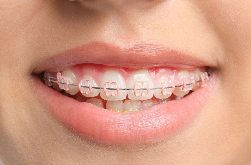 Aparat ortodontyczny – FAQ