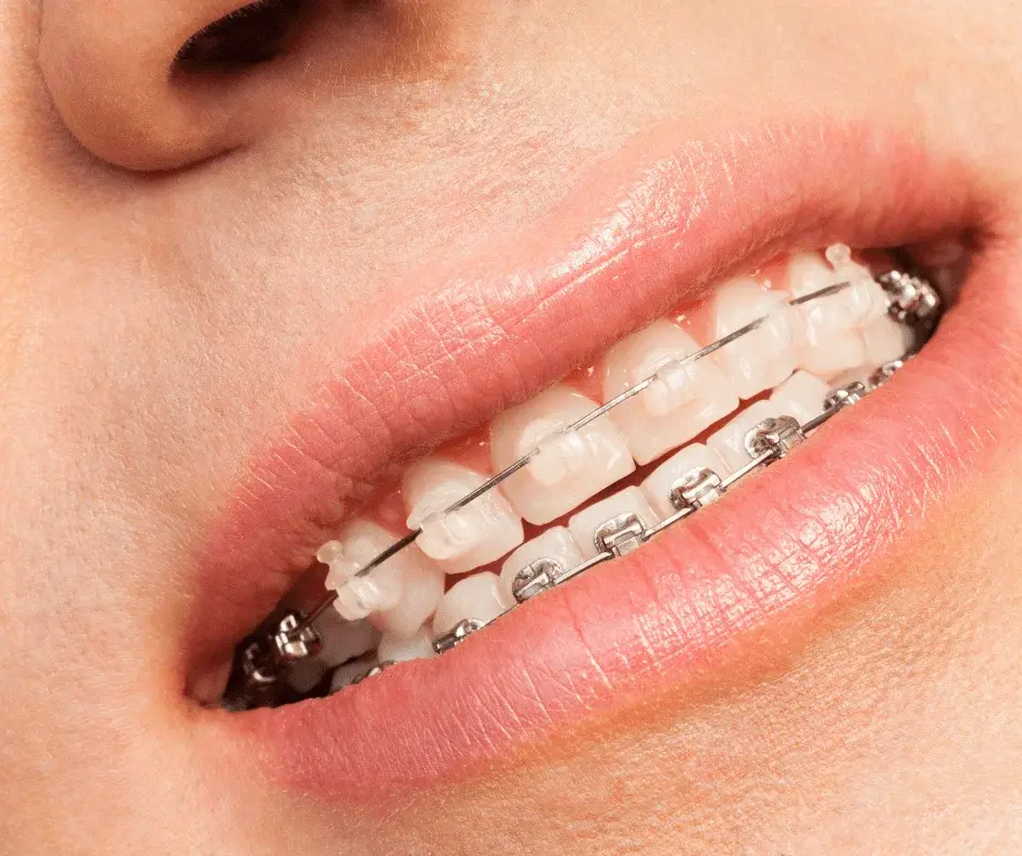 Aparaty ortodontyczne