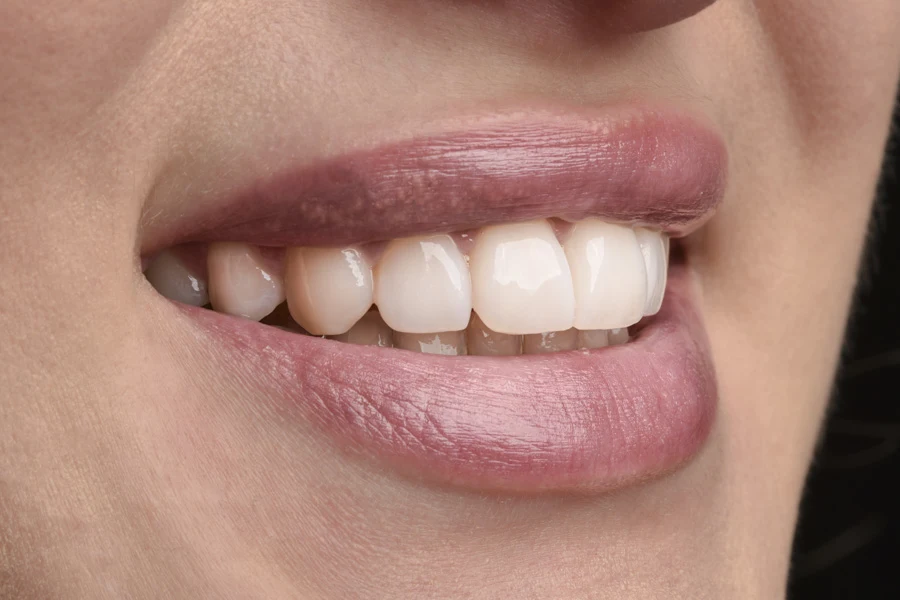 Bonding Stomatologia Estetyczna