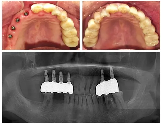 Tomografia Szczeki I Zuchwy