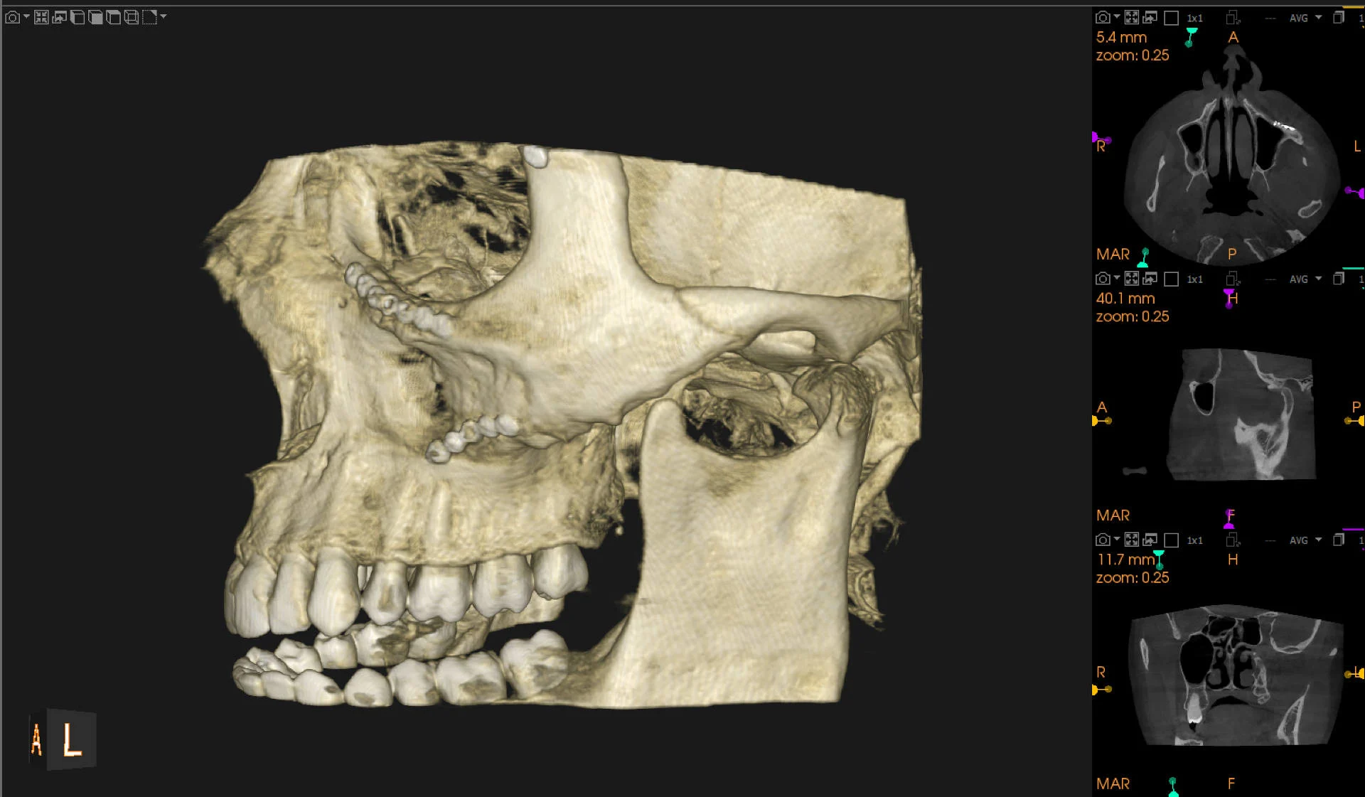 Tomografia Stawow Skroniowo Zuchwowych