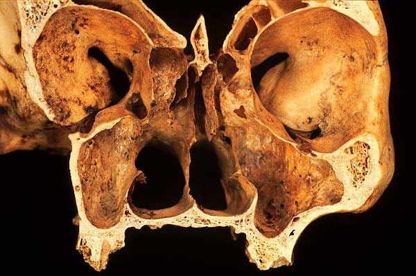 Tomografia Szczeki I Zuchwy