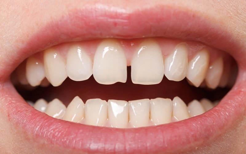 Diastema – wada zgryzu