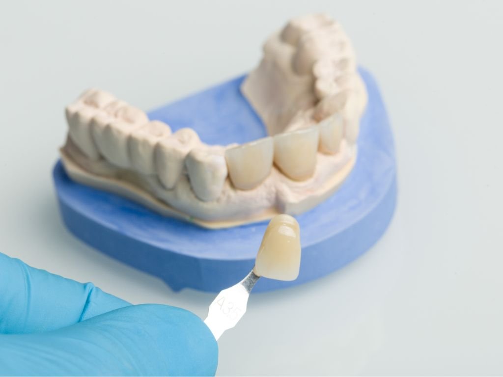 Odbudowa Zeba Na Implancie