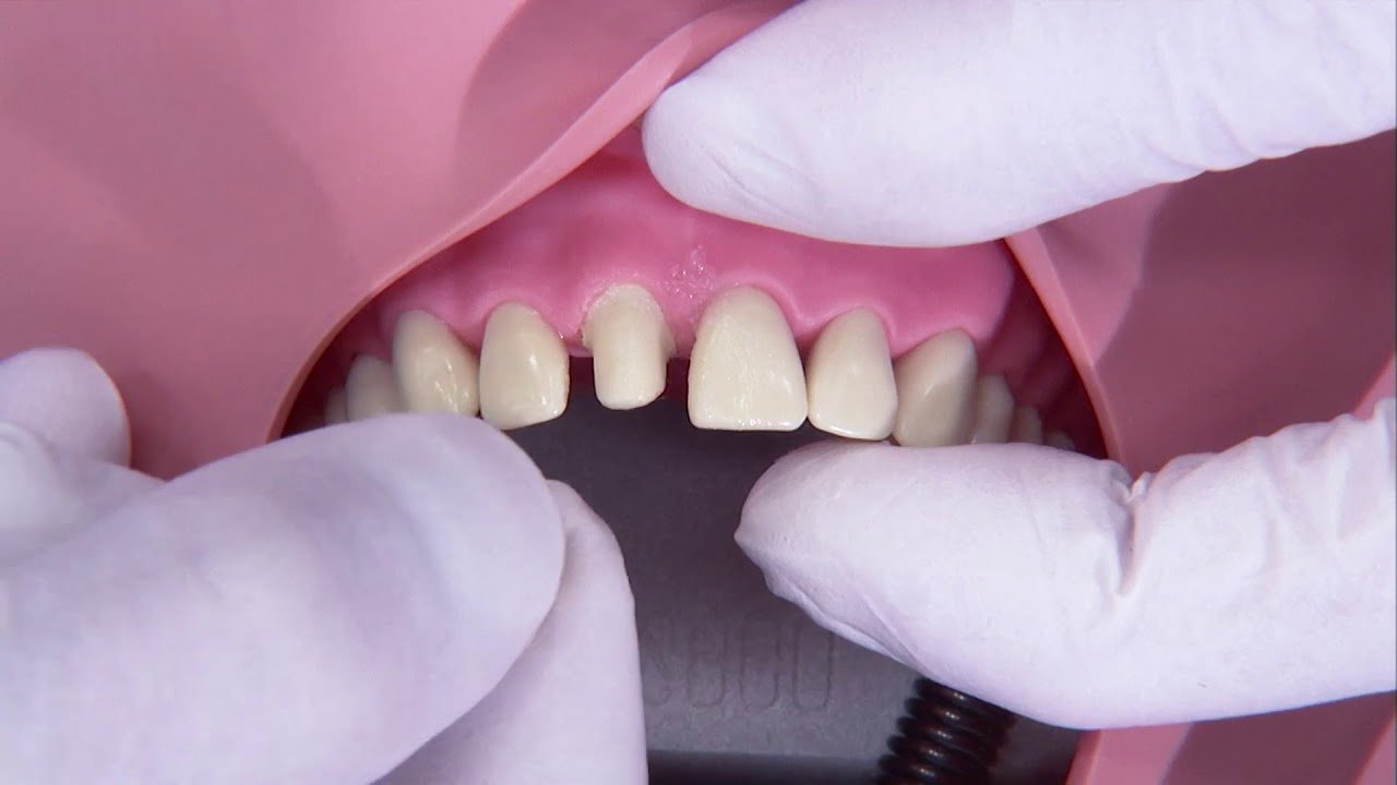 Rekonstrukcja Zgryzu