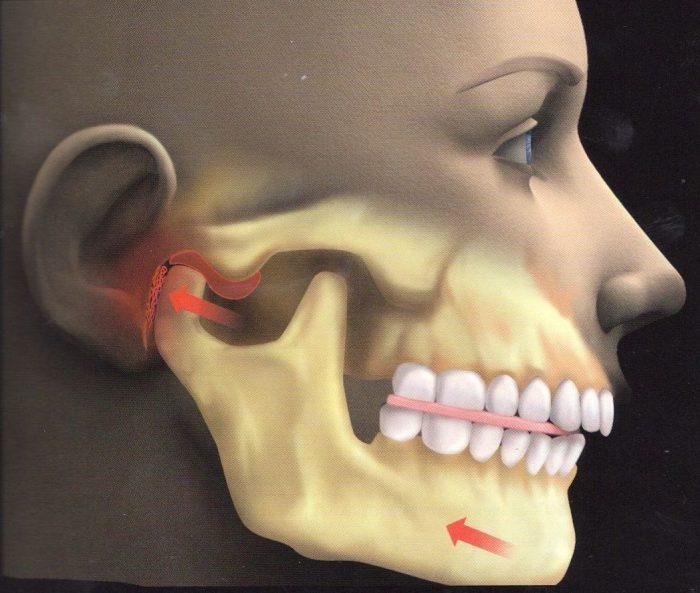 Leczenie Bolu Stawu Skroniowo Zuchwowego