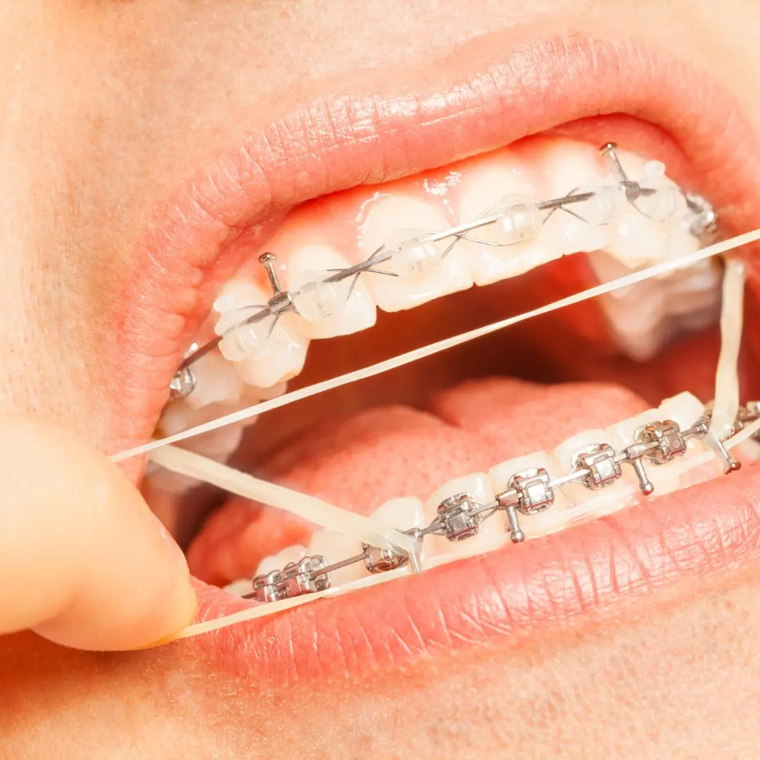 Jak Leczyc Wady Zgryzu