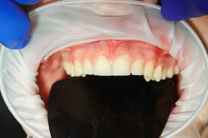 Leczenie ubytków klinowych