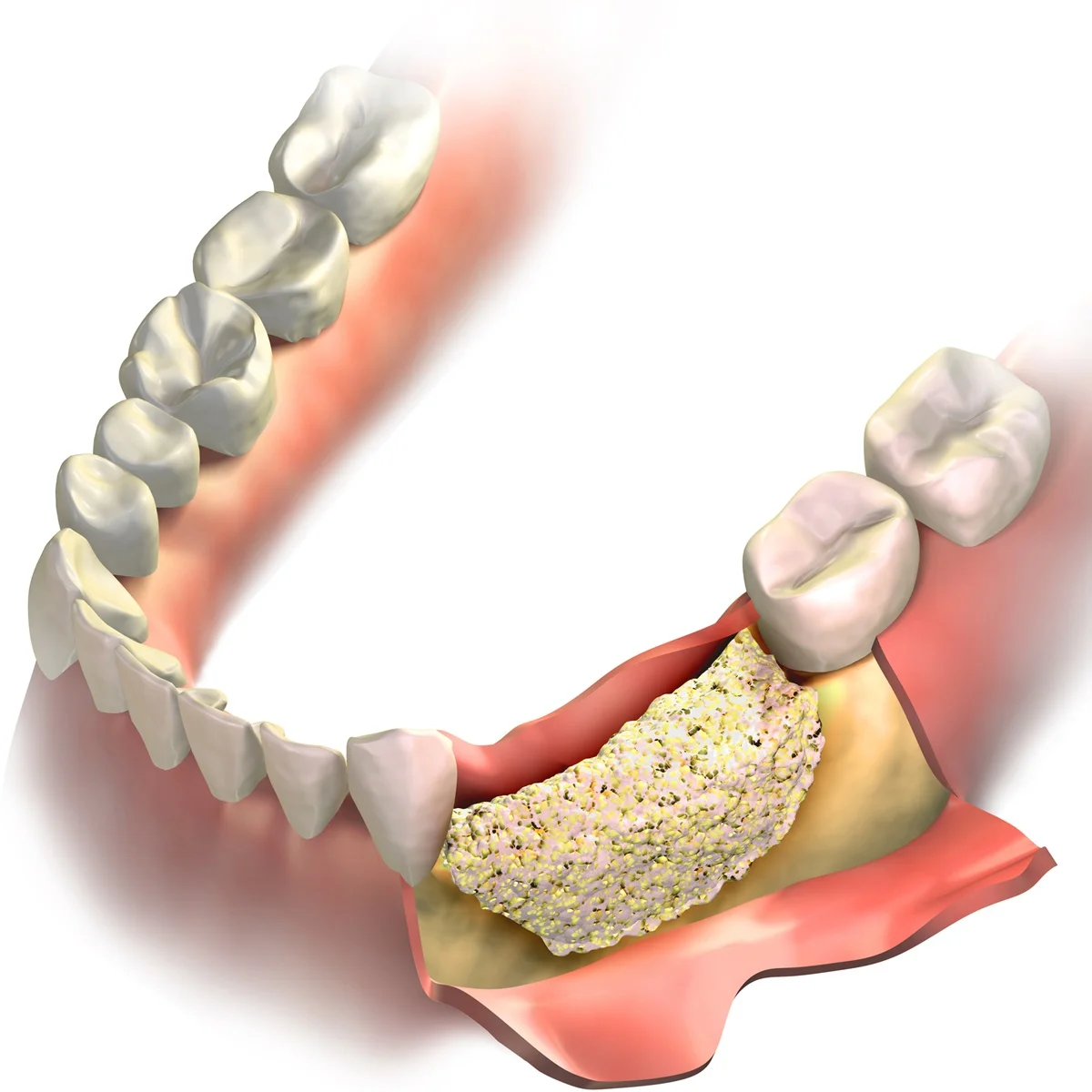 Regeneracja Kosci Pod Implanty