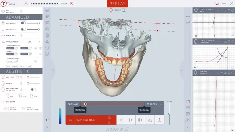 Modjaw Badanie Stawow Skroniowo Zuchwowych