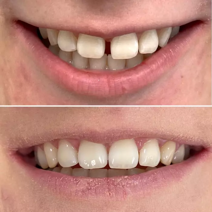 Nakładki Przed I Po