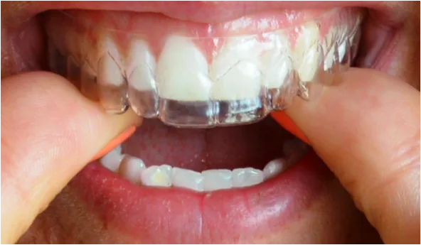 Nakładki ortodontyczne