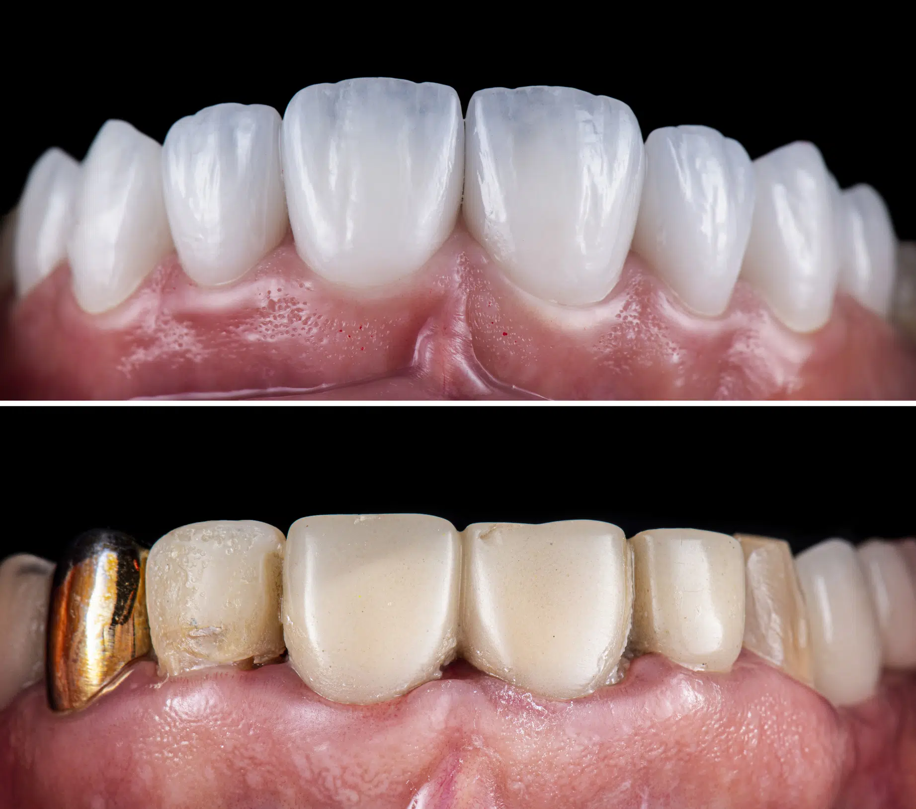 Odbudowa Zeba Na Implancie