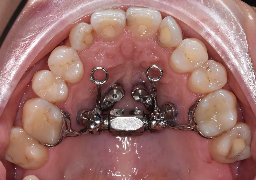 Ortodoncja dziecięca