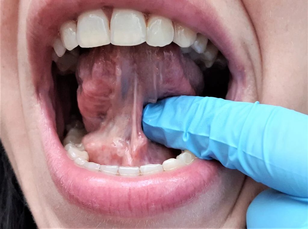 Podcinanie Wedzidelka