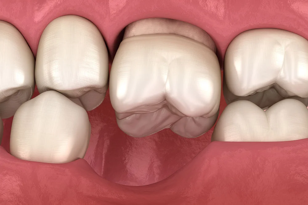 Odbudowa Zeba Na Implancie