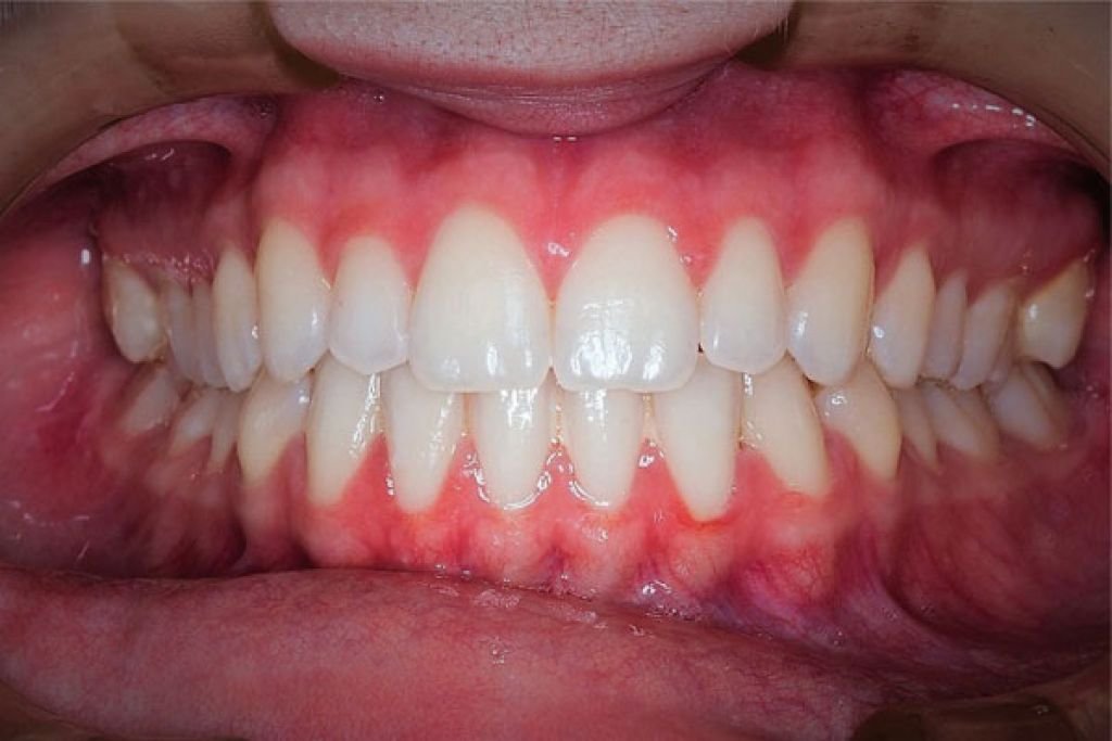 Jak Rozpoznac Wade Zgryzu