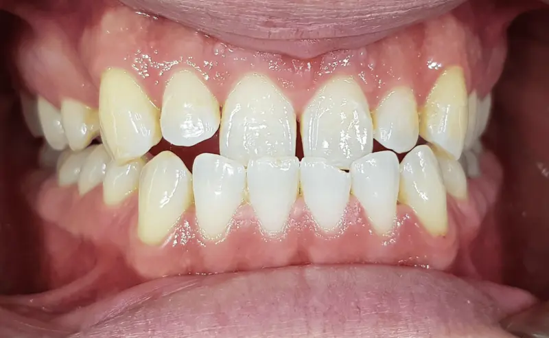 Przodozgryz – wada zgryzu