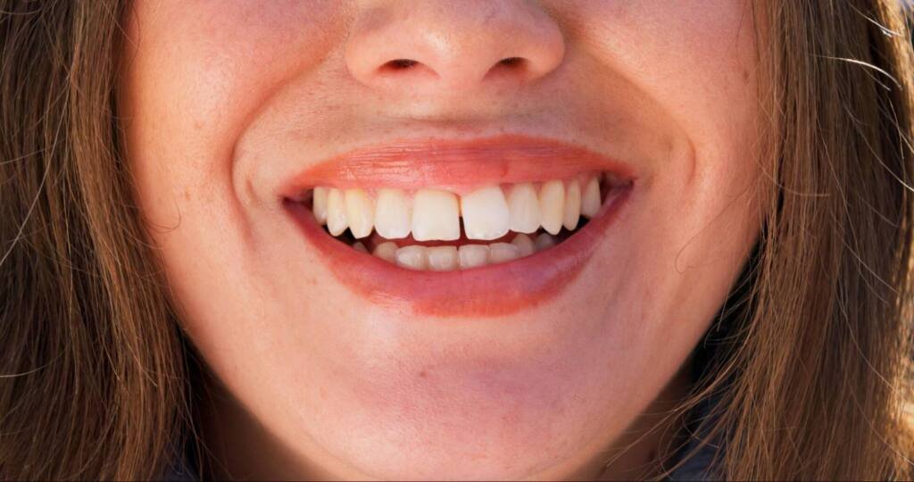 Diastema