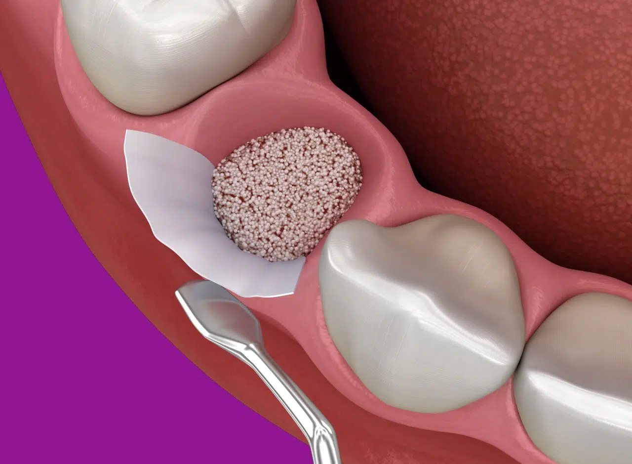 Regeneracja Kosci Pod Implanty