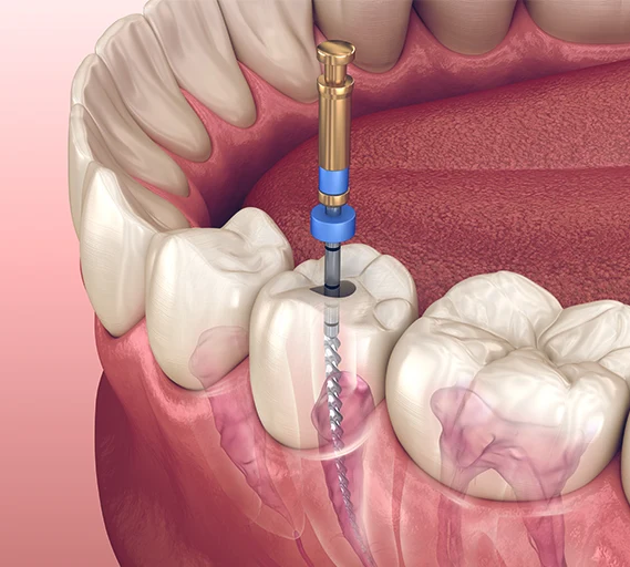 Resekcja Wierzcholka Korzenia