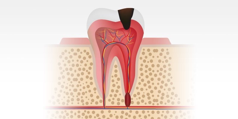 Resekcja Wierzcholka Korzenia
