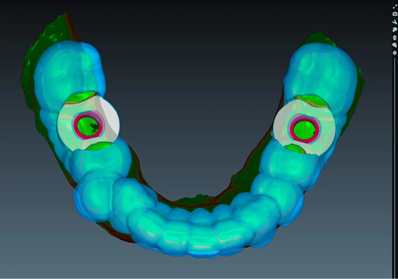 Tomografia Do Implantow