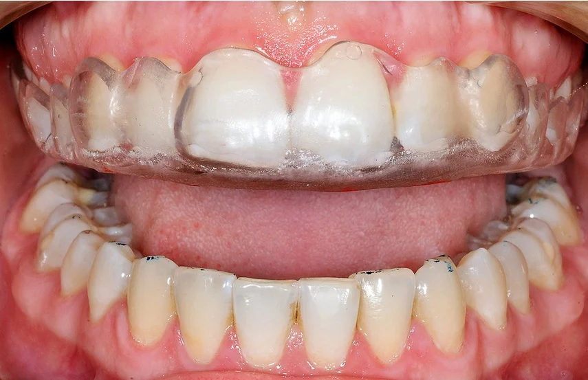 Leczenie Bolu Stawu Skroniowo Zuchwowego