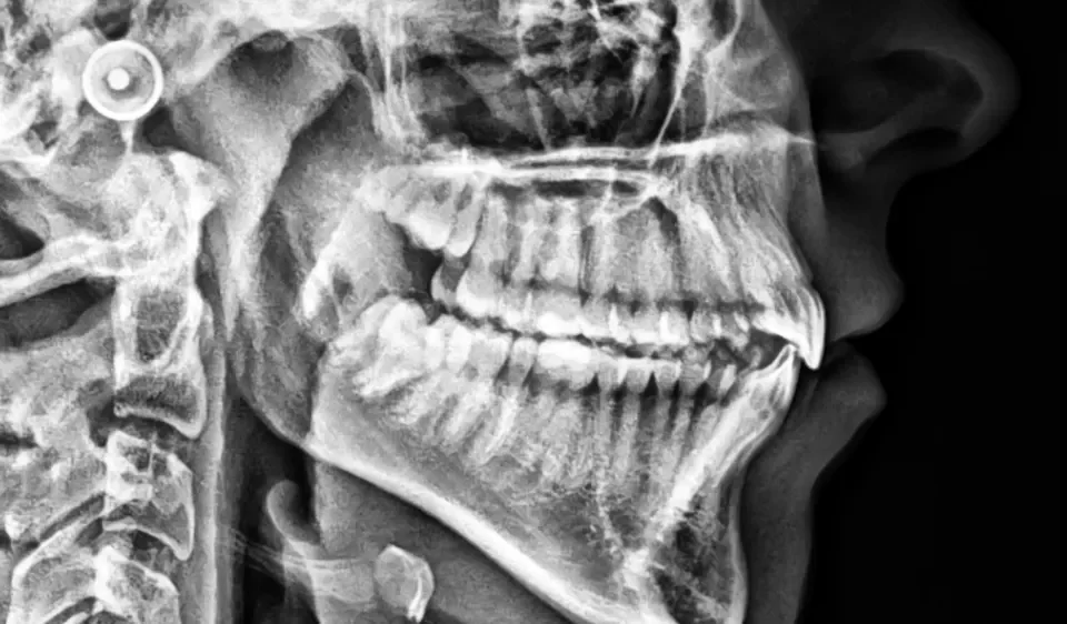 Tomografia CBCT zębów
