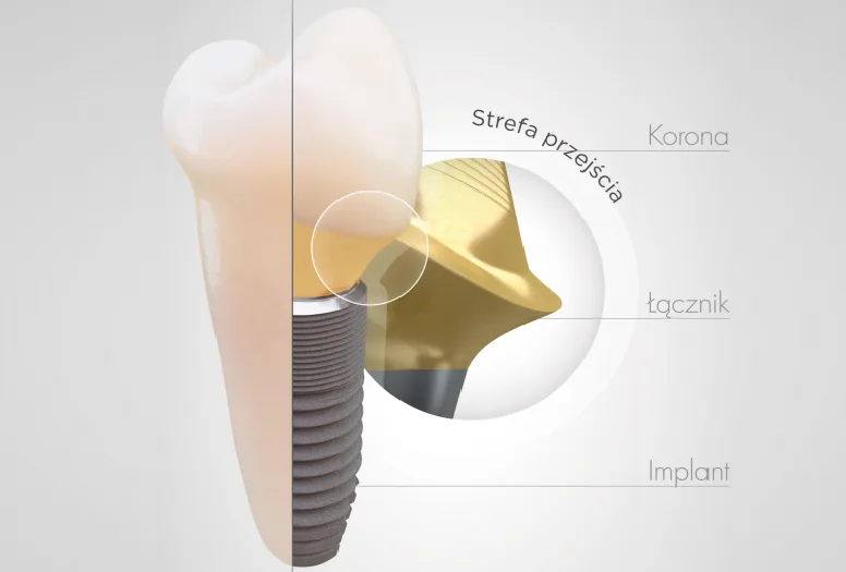 Korona Na Implancie