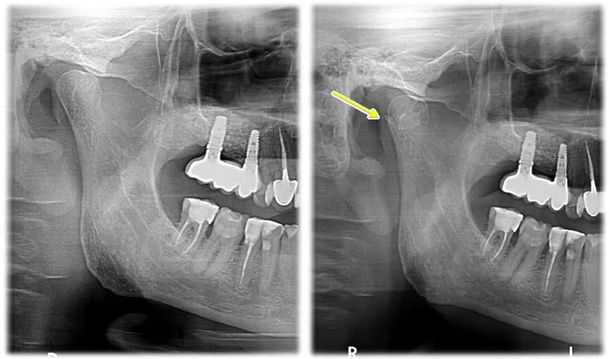 Tomografia Stawow Skroniowo Zuchwowych