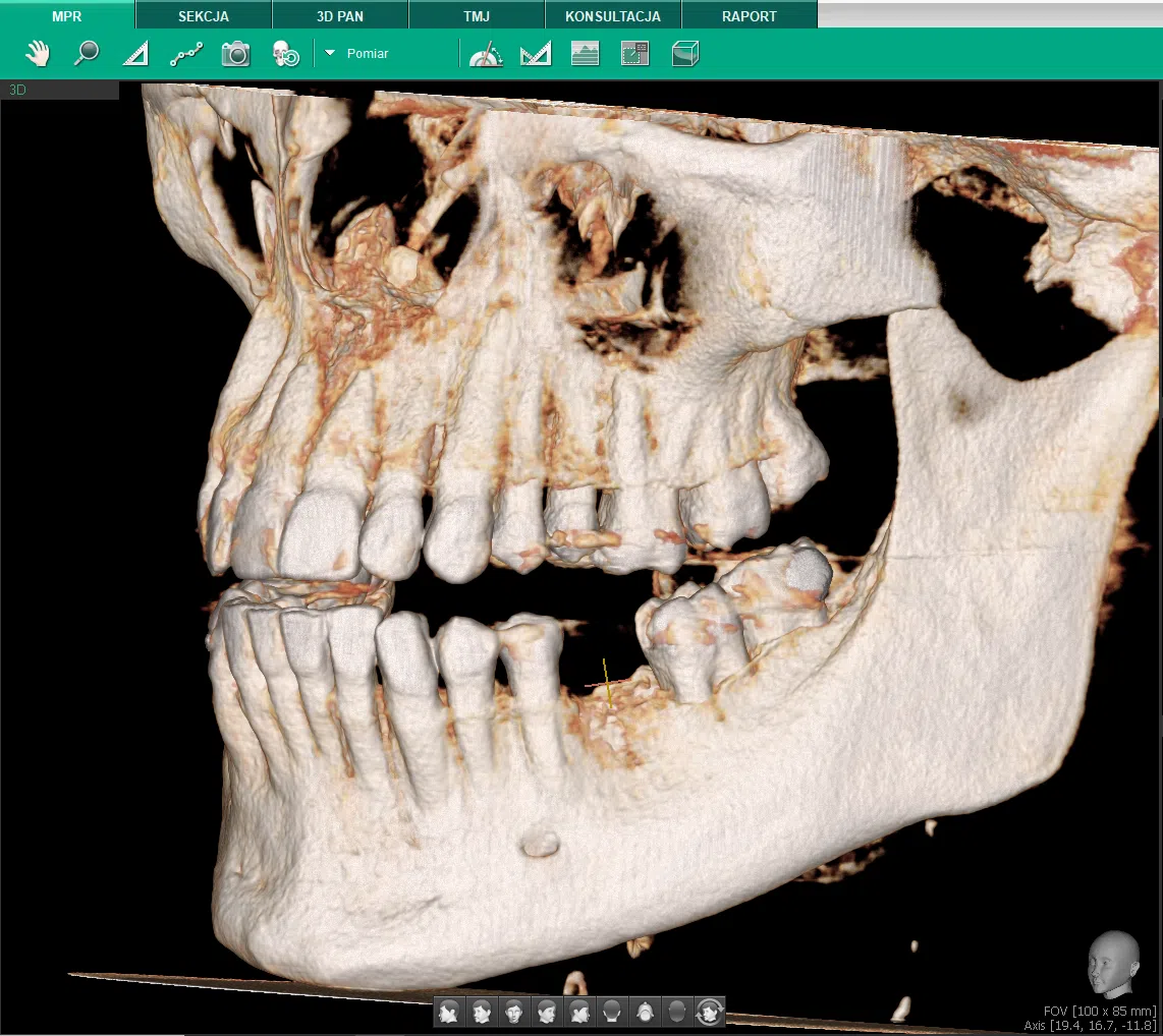 Tomografia Szczeki I Zuchwy
