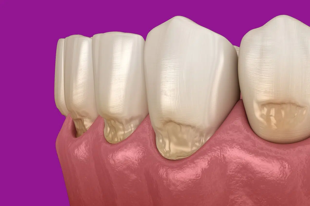 Leczenie ubytków klinowych