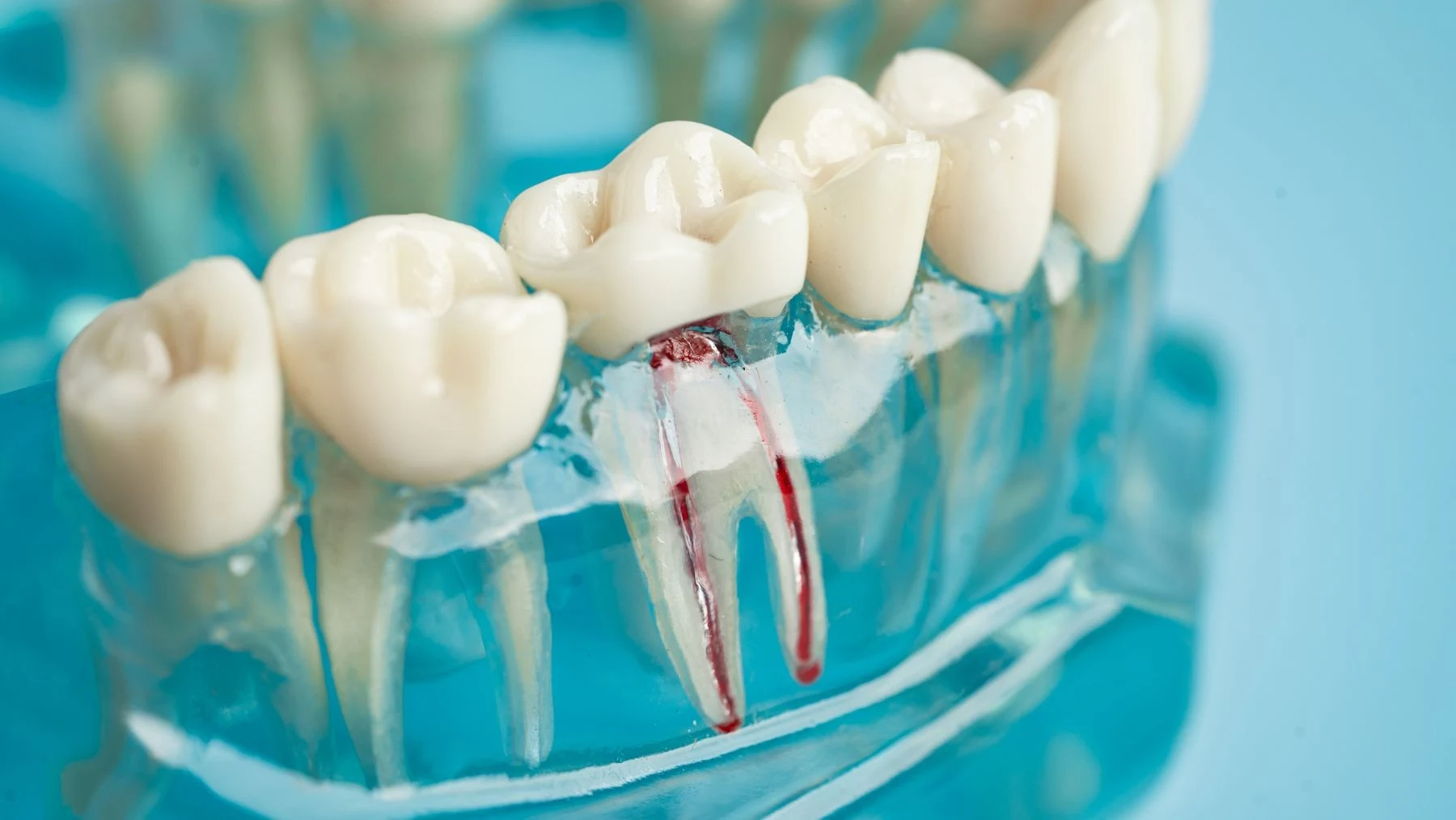 Odbudowa zęba po leczeniu kanałowym